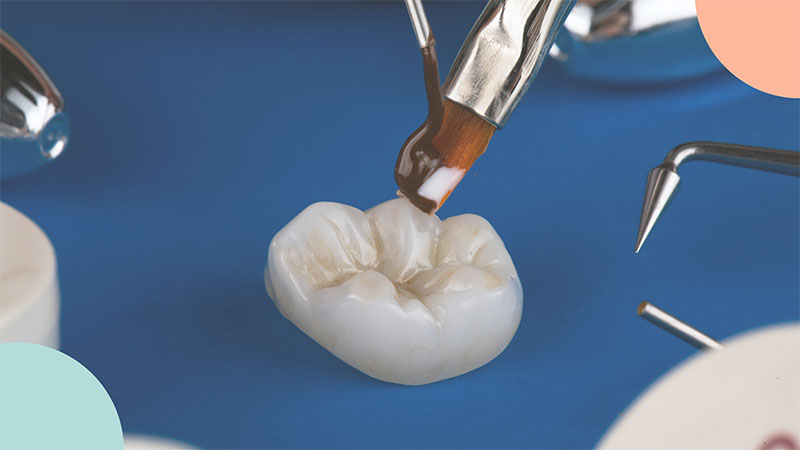 All About Dental Crowns: What They Are and When You Need Them